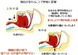 東京都・文京区の顎関節症・かみ合わせ治療専門医院｜グリーン歯科医院のナイトデンチャー